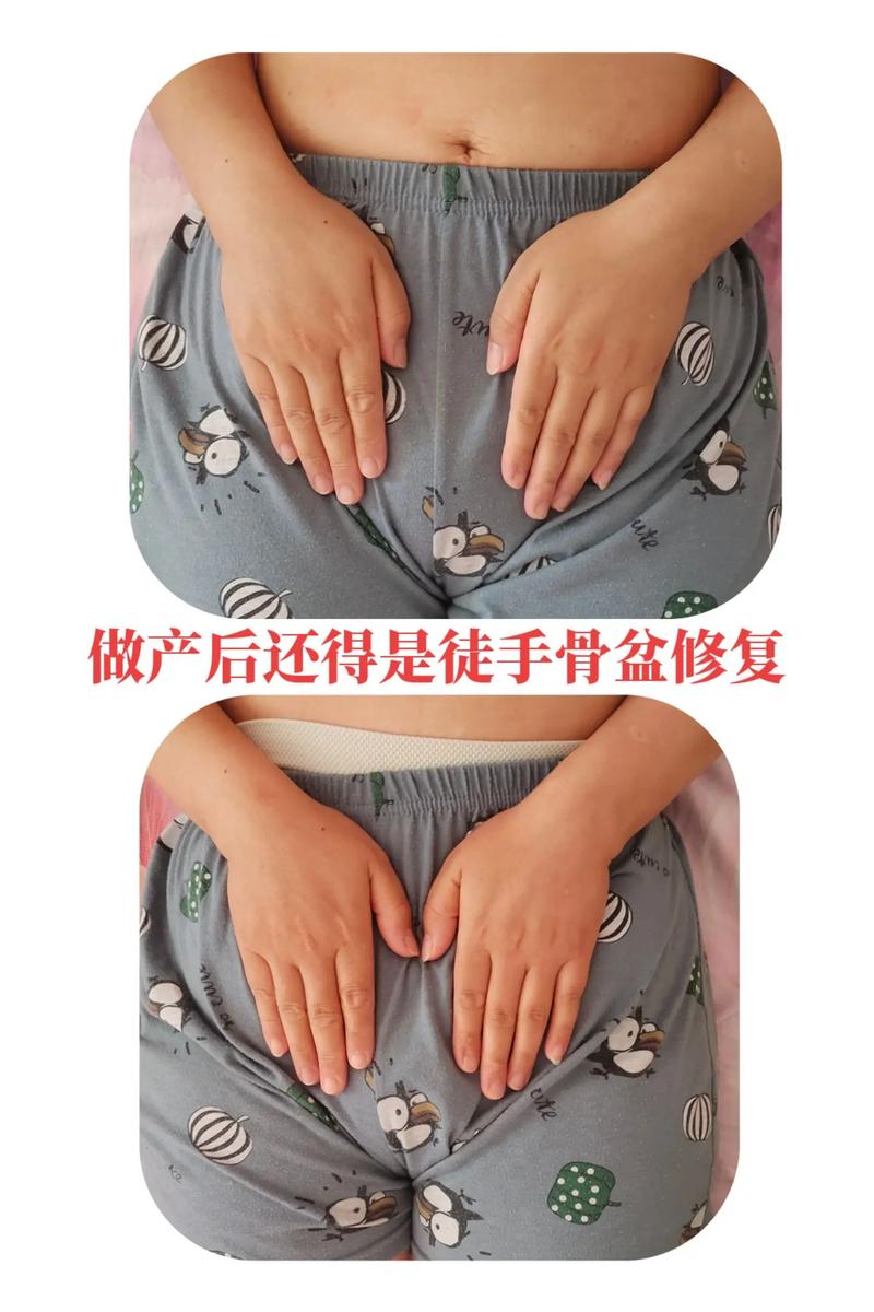产后修复